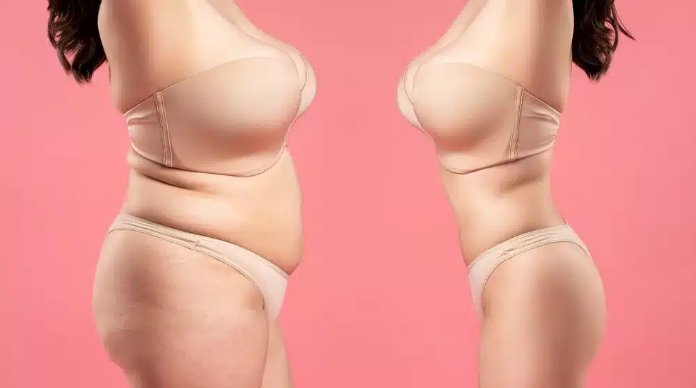 Tummy tuck mommy makeover Beverly Hills