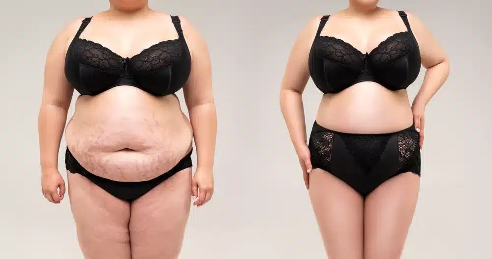Understanding the Tummy Tuck and mommy makeover in Beverly Hills