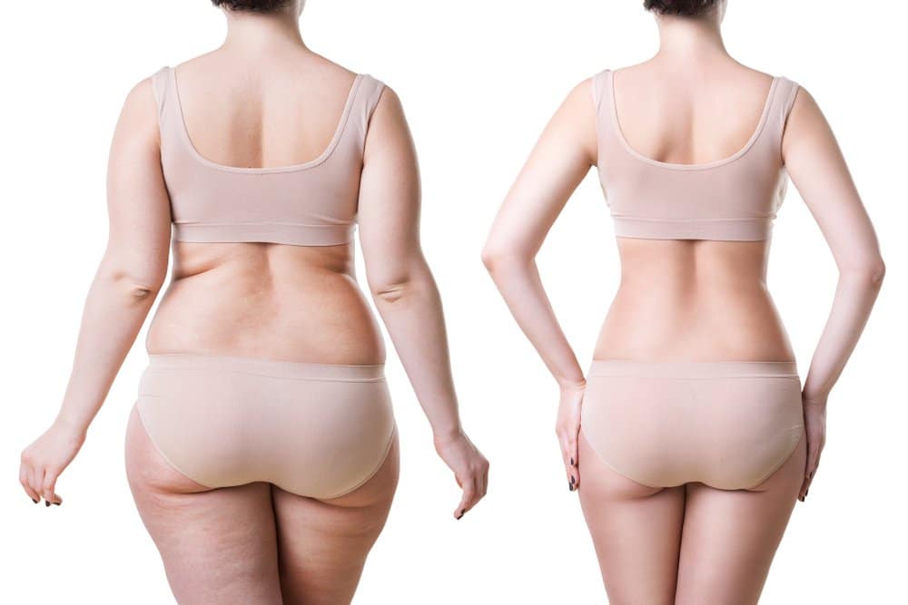 Comparing the Costs Lipo HD vs Lipo Normal