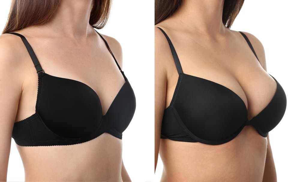 Factors Affecting the Cost of BBL with Breast Augmentation