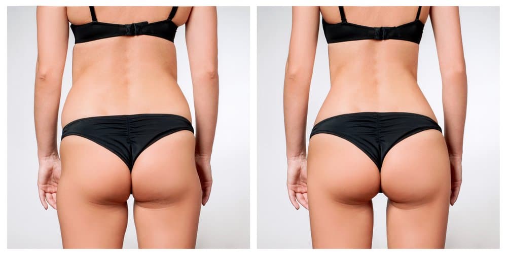 Lipo HD Vs. Lipo Normal