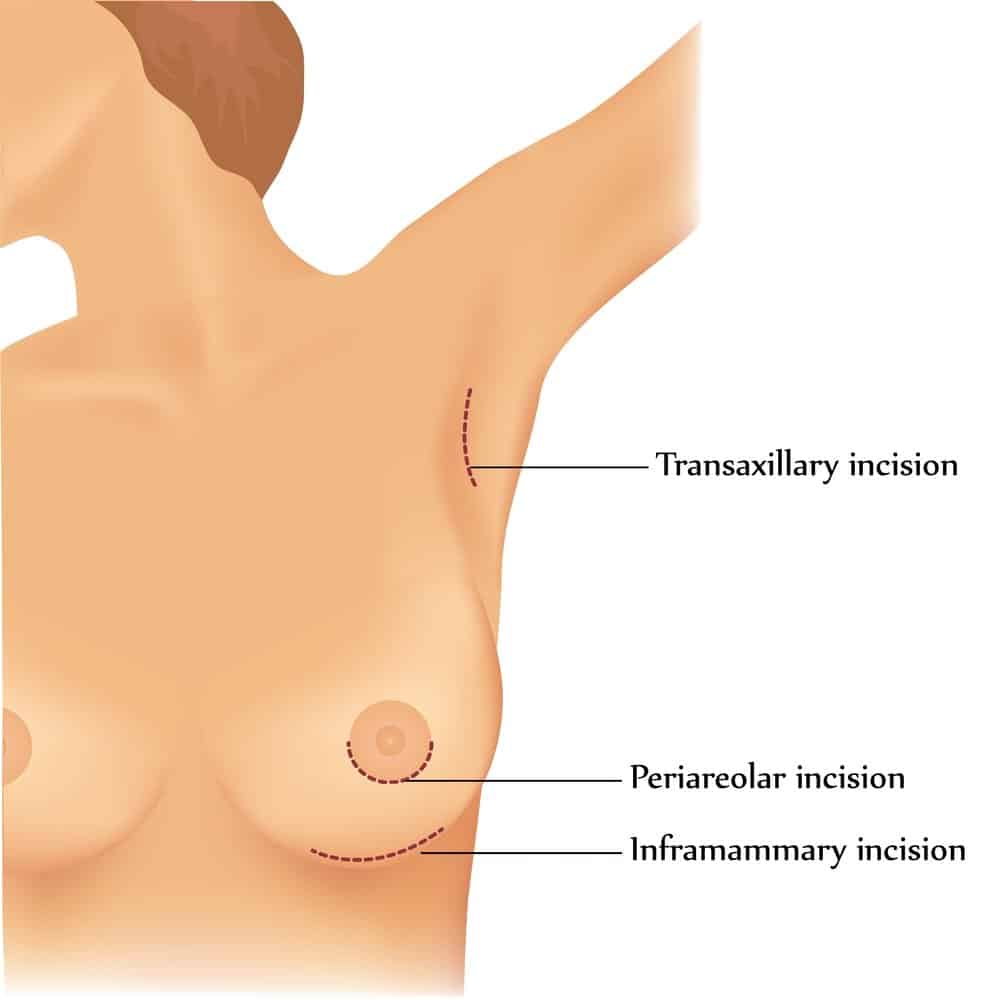What Is Transaxillary Breast Augmentation