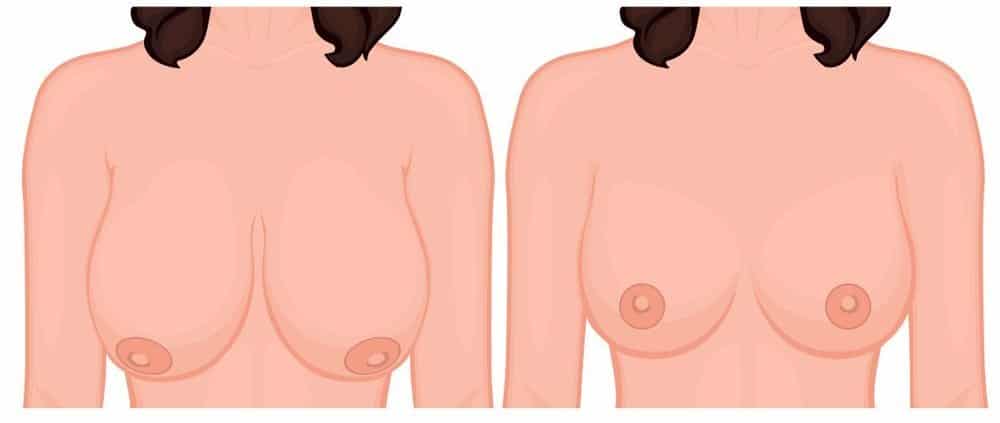 What Is a Lipolift Breast Reduction