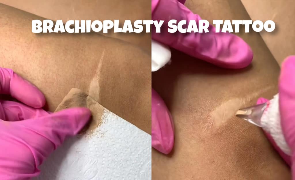 Brachioplasty Scar Tattoo
