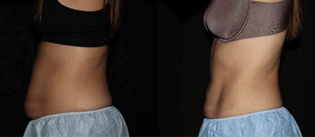 CoolSculpting before and after