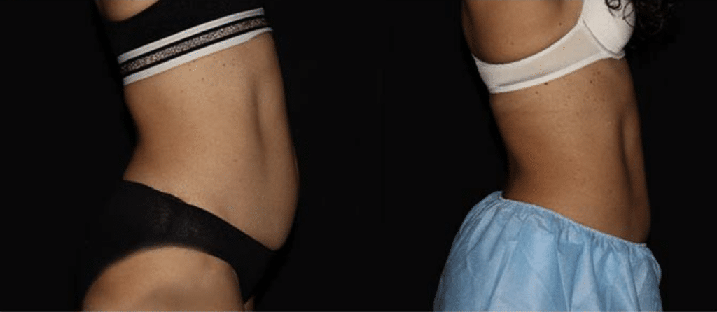 Cryolipolysis before and after 1