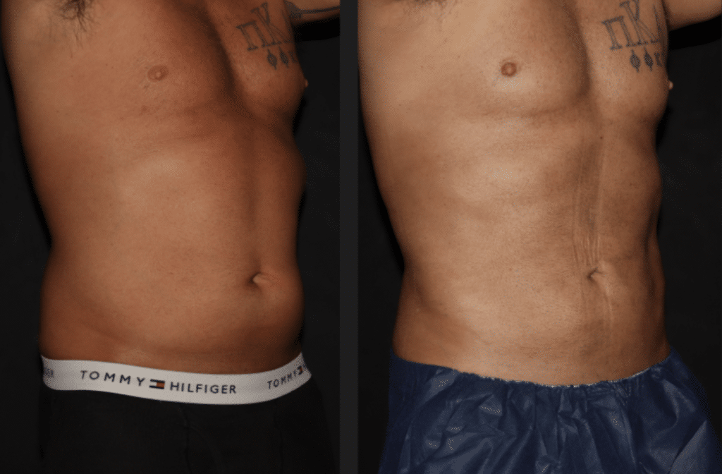 Laser Lipo