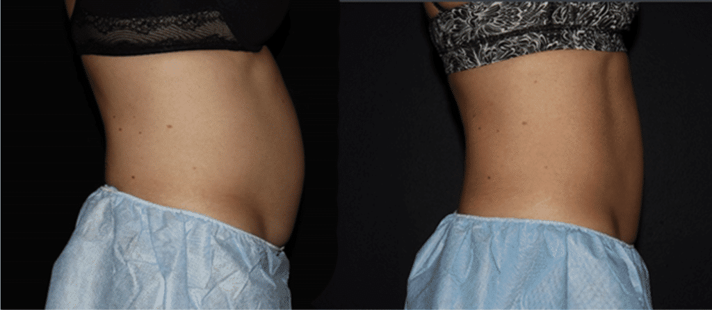 Non Surgical Body Contouring