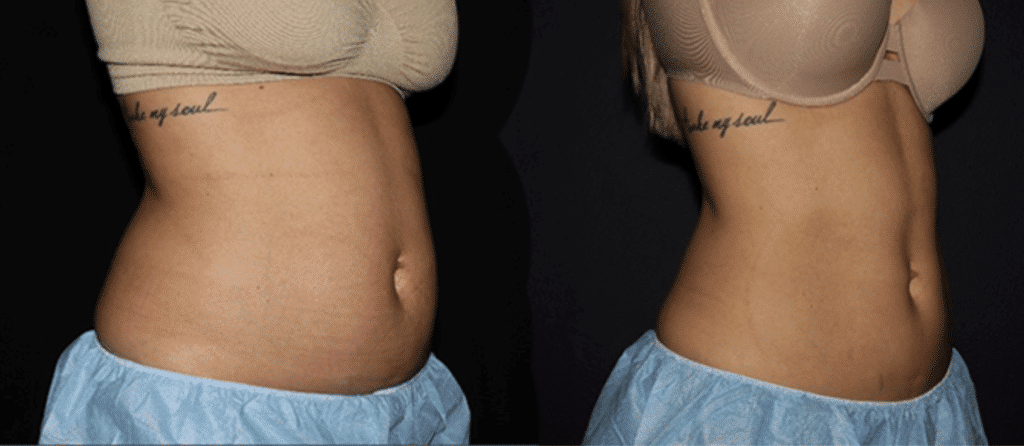 How Long Does It Take to See Results From Body Sculpting?, Kansas City  Non-Surgical Body Contouring