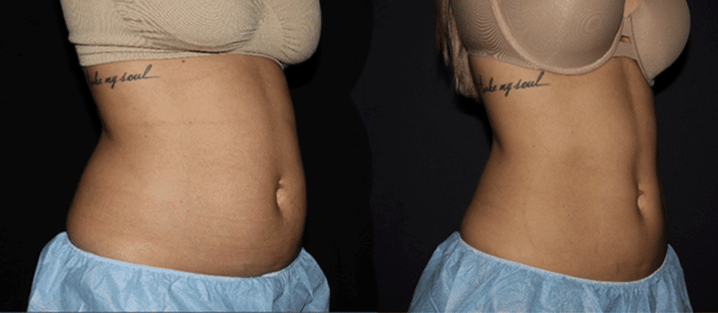 Non Surgical Body Contouring Before And After