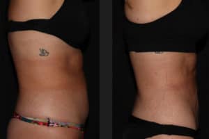 Non Surgical Body Contouring Before And After