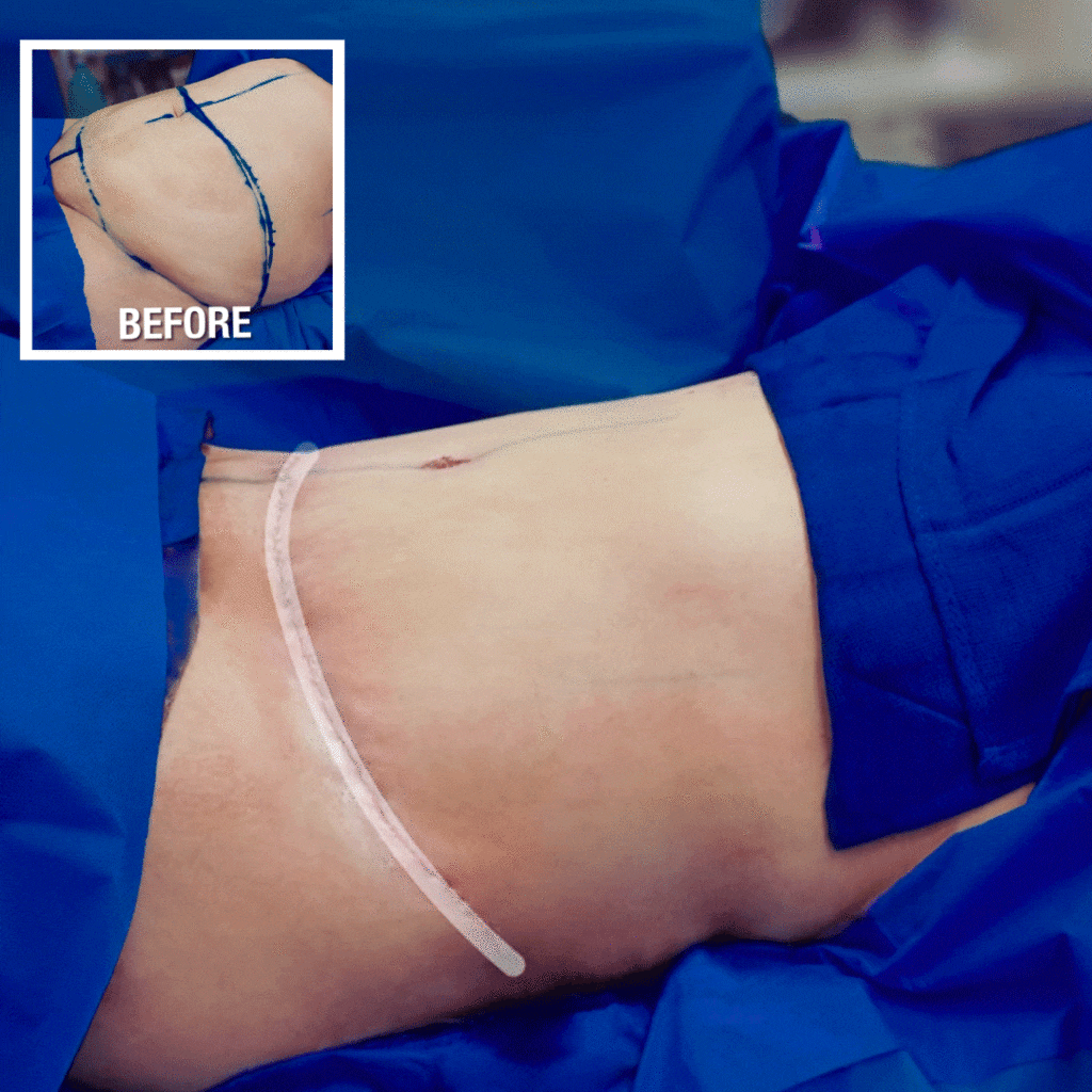 Tummy Tuck Abdominoplasty