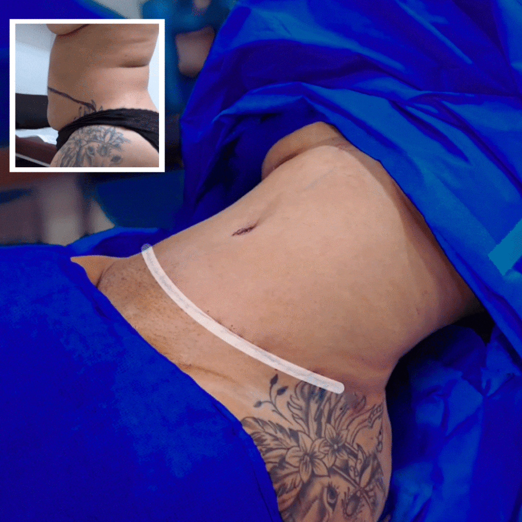 Tummy Tuck with Liposuction on the flanks