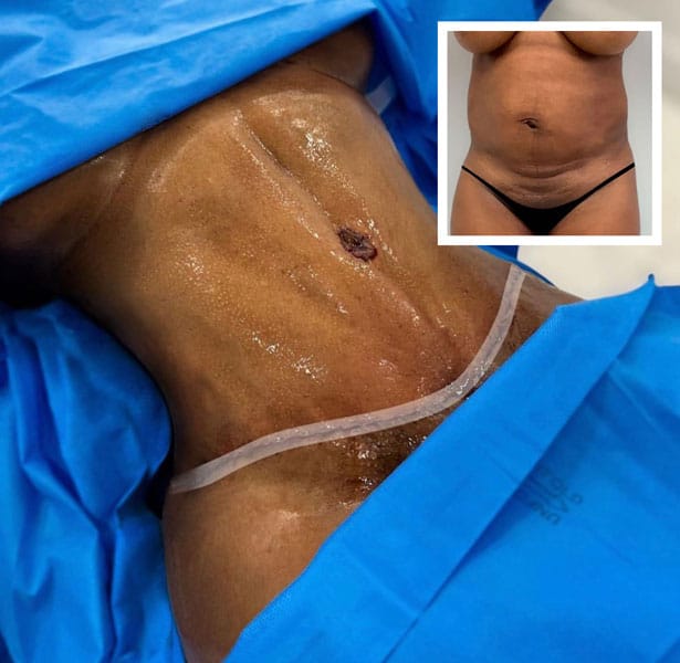 Pre and post operative tummy tuck patient images