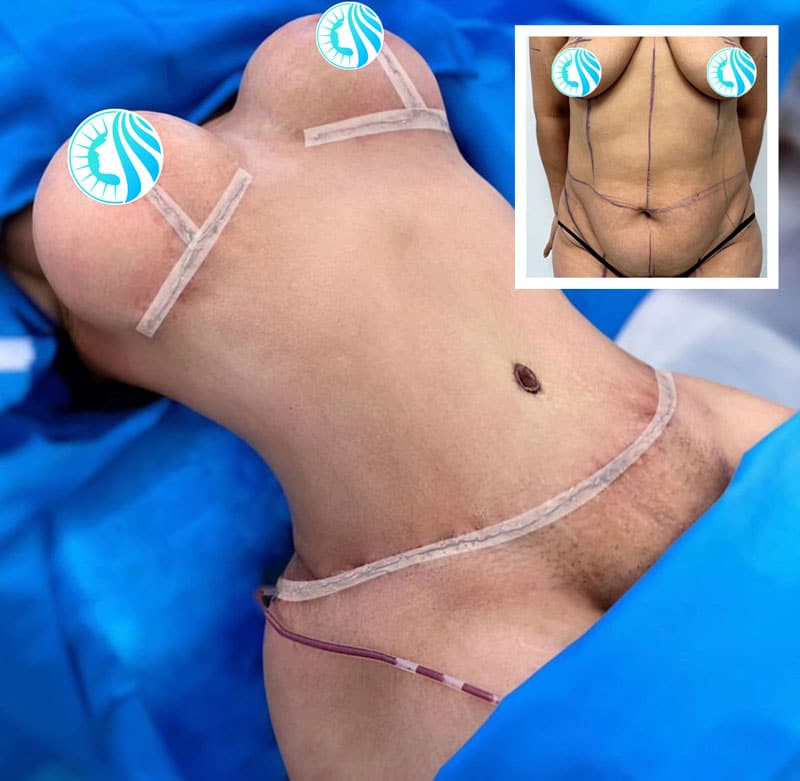 TUMMY TUCK BEFORE AND AFTER SURGERY